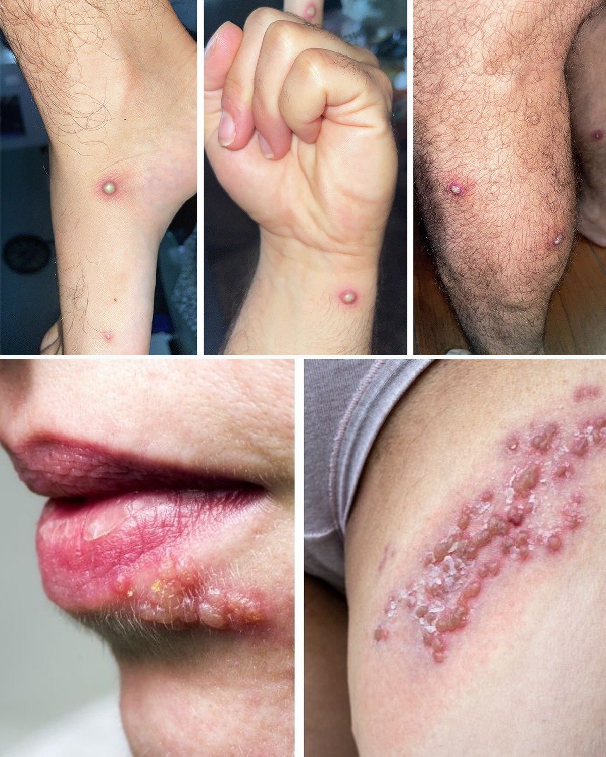 Recurrent Rashes or Blisters on Lips or Private Areas? This Is NOT Normal – Here’s What Your Body Is Telling You