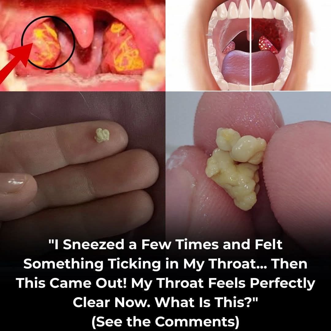 How to get rid of tonsil stones in a natural and simple way