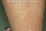What’s Behind Those White Spots on Your Skin?