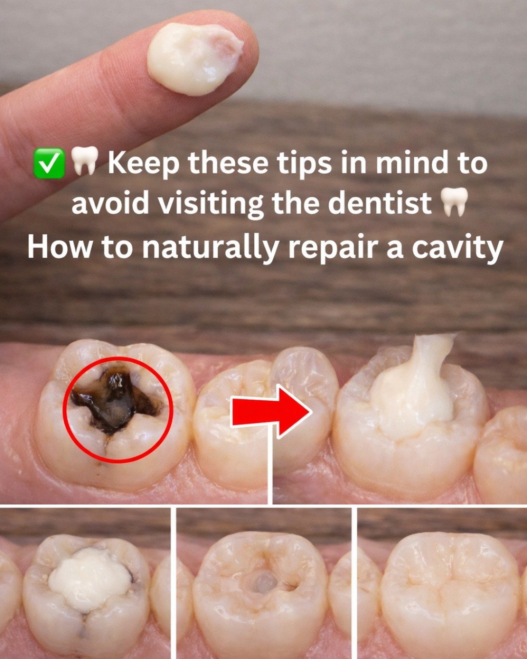 Say Goodbye to Early Cavities: 11 Natural Ways to Support Tooth Remineralization and Halt Early Decay
