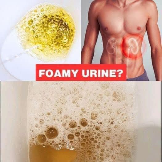 If Your Urine Is Foamy Like This, It Could Be A Warning Sign! (Proteinuria)