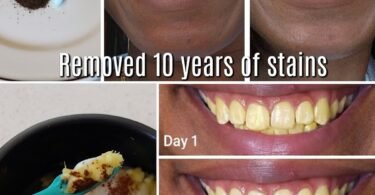 In Just 2 Minutes, Remove 10 Years of Teeth Stains – The Natural Whitener That Actually Works