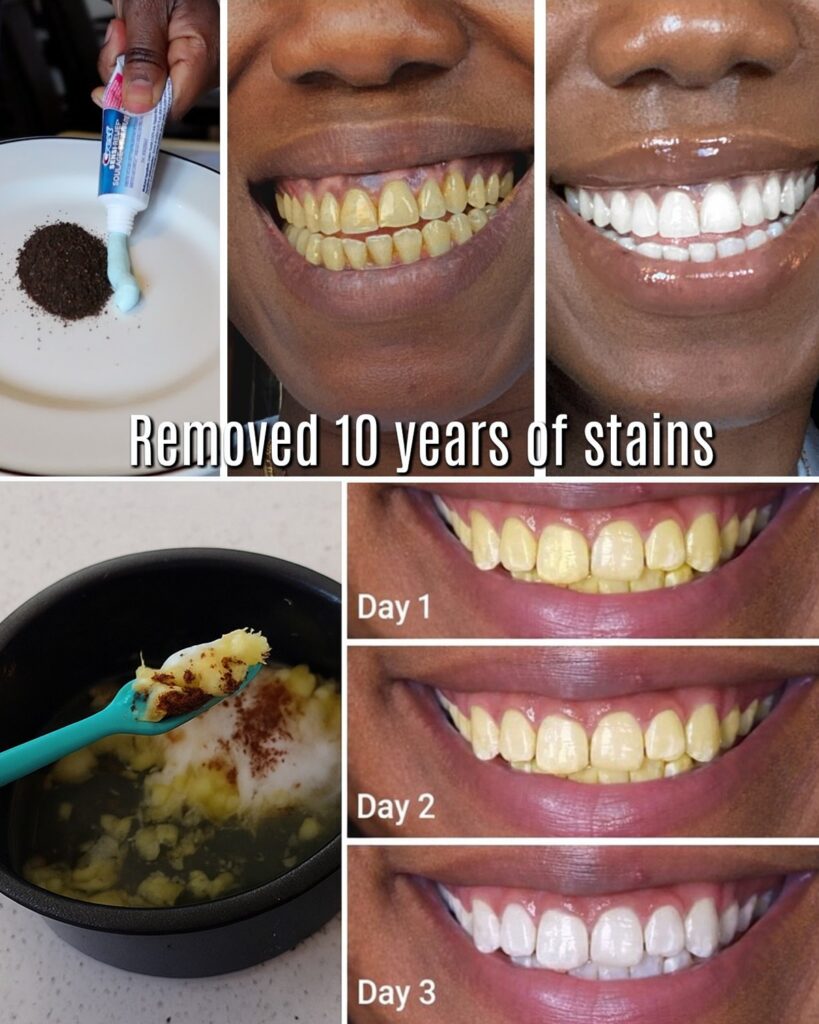 In Just 2 Minutes, Remove 10 Years of Teeth Stains – The Natural Whitener That Actually Works