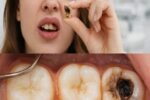 Keep These Tips in Mind to Avoid Visiting the Dentist: How to Naturally Support Early Cavity Repair