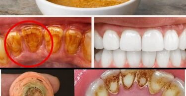 Home Teeth Whitening: Get Whiter Teeth in Just 2 Minutes!