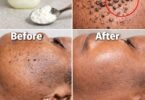 Those Stubborn Little White Bumps: Understanding Milia and Safe Ways to Improve Your Skin’s Appearance