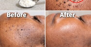 Those Stubborn Little White Bumps: Understanding Milia and Safe Ways to Improve Your Skin’s Appearance