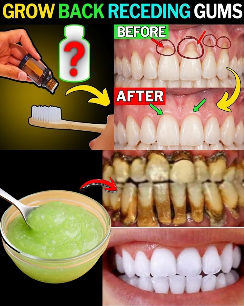9 Natural Remedies That May Help Support Receding Gums and Promote Healthier Smiles