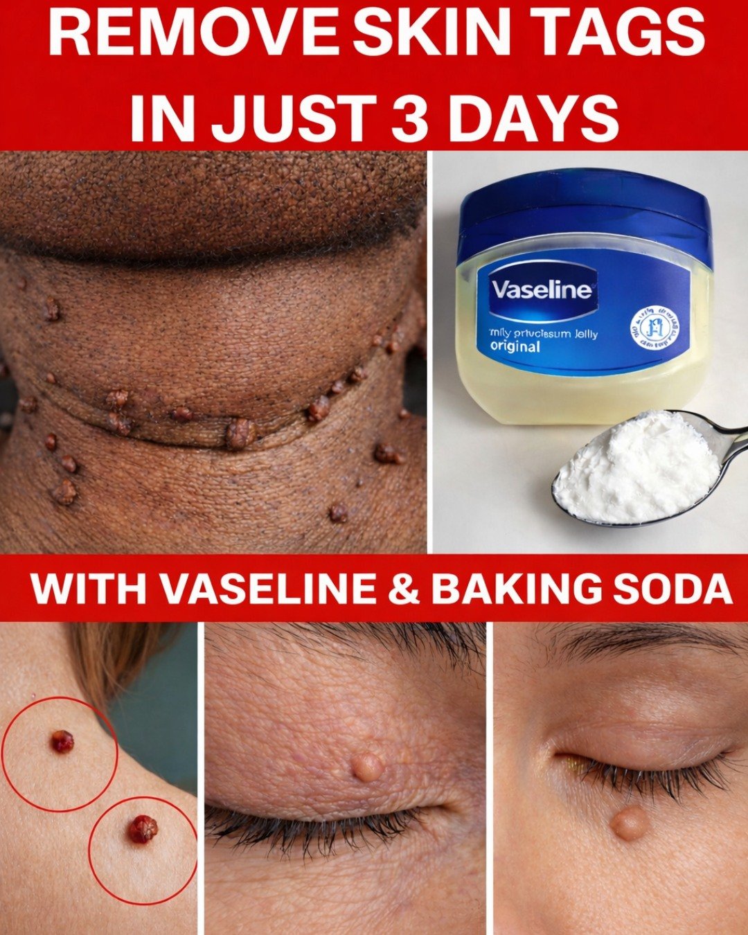 How to Manage Annoying Skin Tags Naturally at Home (Including Simple Vaseline Tips)