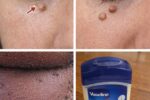 Those Stubborn Little White Bumps: Understanding Milia and Safe Ways to Improve Your Skin’s Appearance