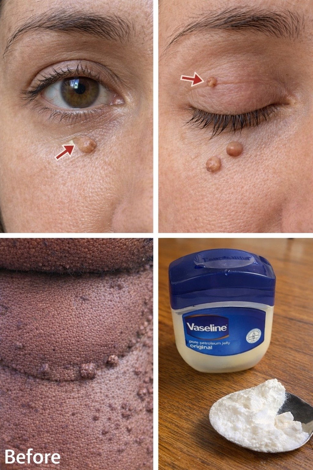 Those Stubborn Little White Bumps: Understanding Milia and Safe Ways to Improve Your Skin’s Appearance