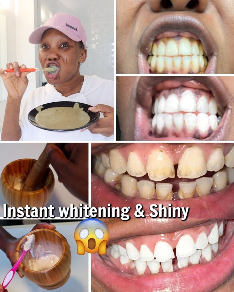 How to Naturally Whiten Yellow Teeth at Home: The Powerful Banana-Ginger-Lemon Secret Thousands Are Raving About