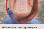 Vertical Lines on Your Nails After 40: What They Might Mean and How to Care for Them