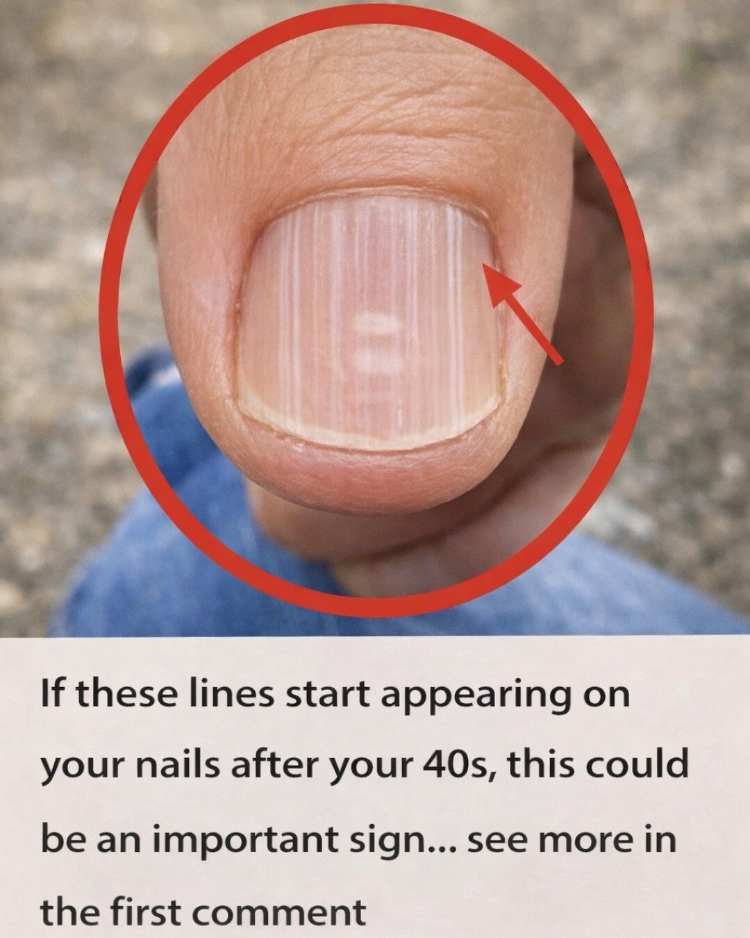 Vertical Lines on Your Nails After 40: What They Might Mean and How to Care for Them
