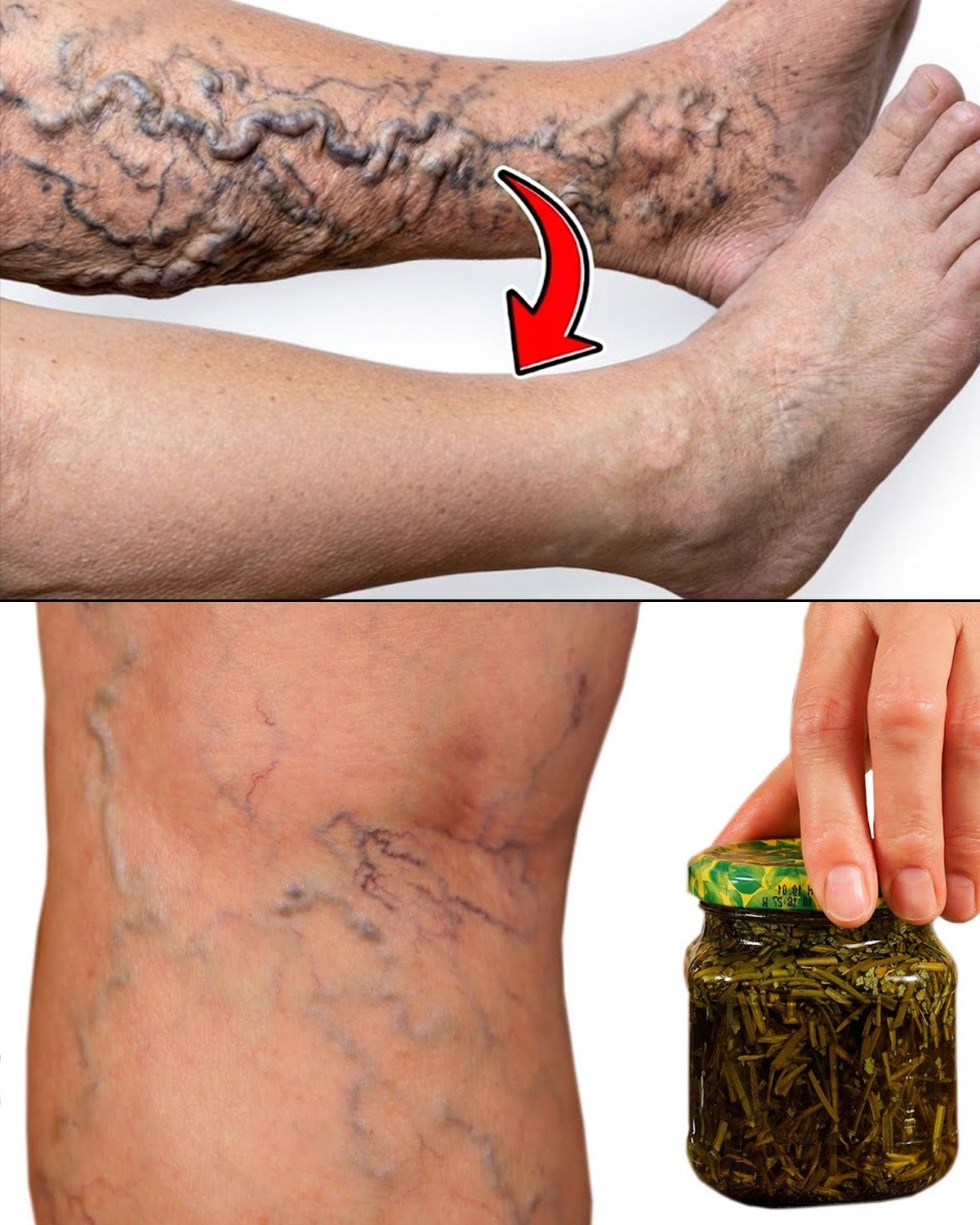 Unbelievable Discovery: How Rosemary May Support Varicose Vein Wellness and Leg Comfort – What 23% of Americans Need to Know