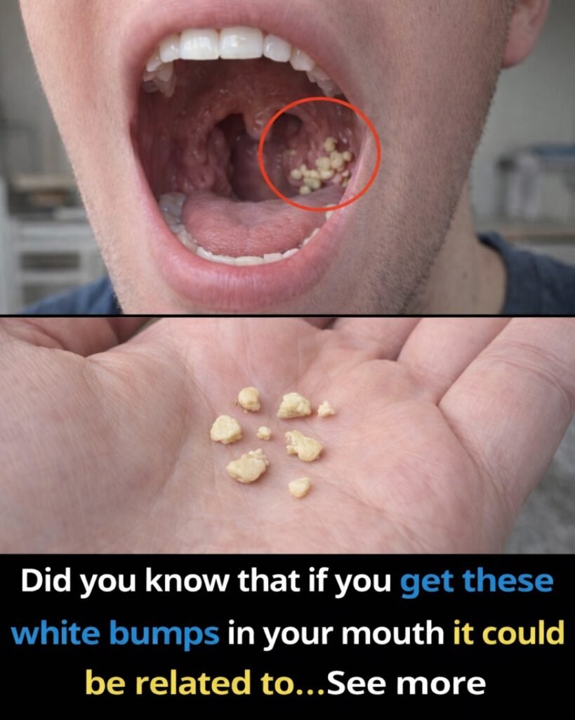 Why These Tiny White Balls Appear in Your Throat (And How to Stop Them)