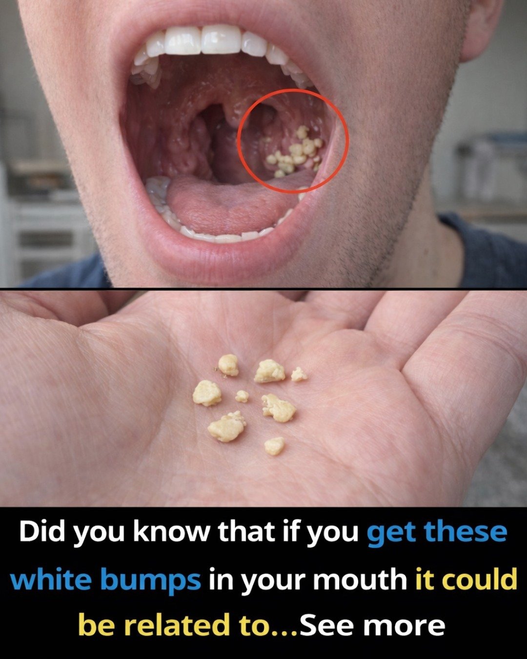Why These Tiny White Balls Appear in Your Throat (And How to Stop Them)