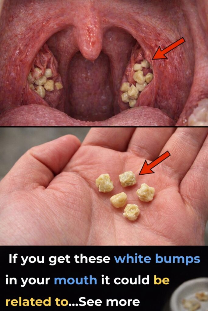 What Are Those White Bumps in Your Mouth? Discover If They’re Tonsil Stones and Everyday Habits to Know