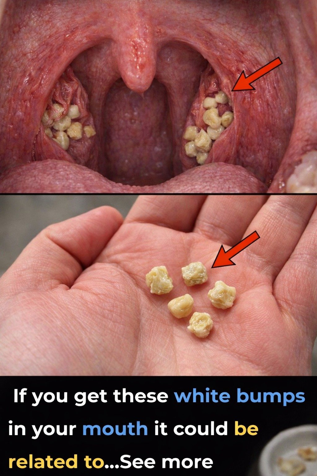 What Are Those White Bumps in Your Mouth? Discover If They’re Tonsil Stones and Everyday Habits to Know