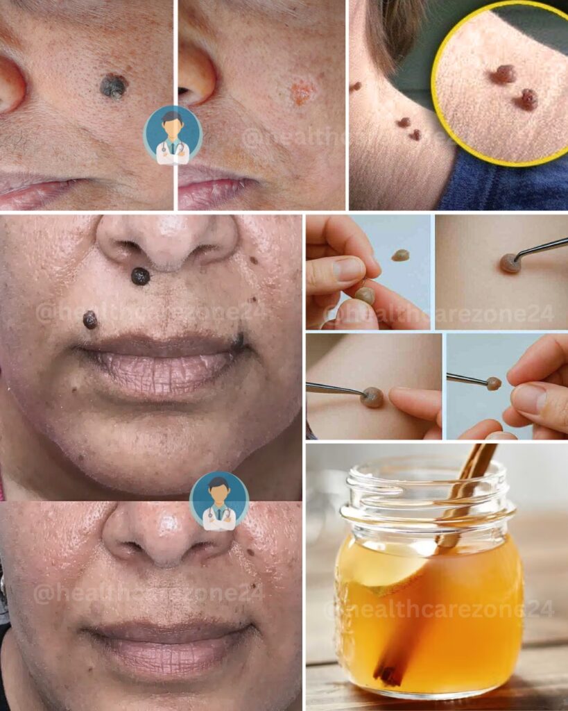 Safe At-Home Wart Removal Methods