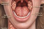 Symptoms Caused by HPV in the Throat: Early Signs, Subtle Changes, and What People Often Miss