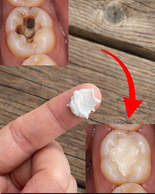 5 Simple Natural Home Remedies to Help Prevent Cavities and Support Healthy Teeth