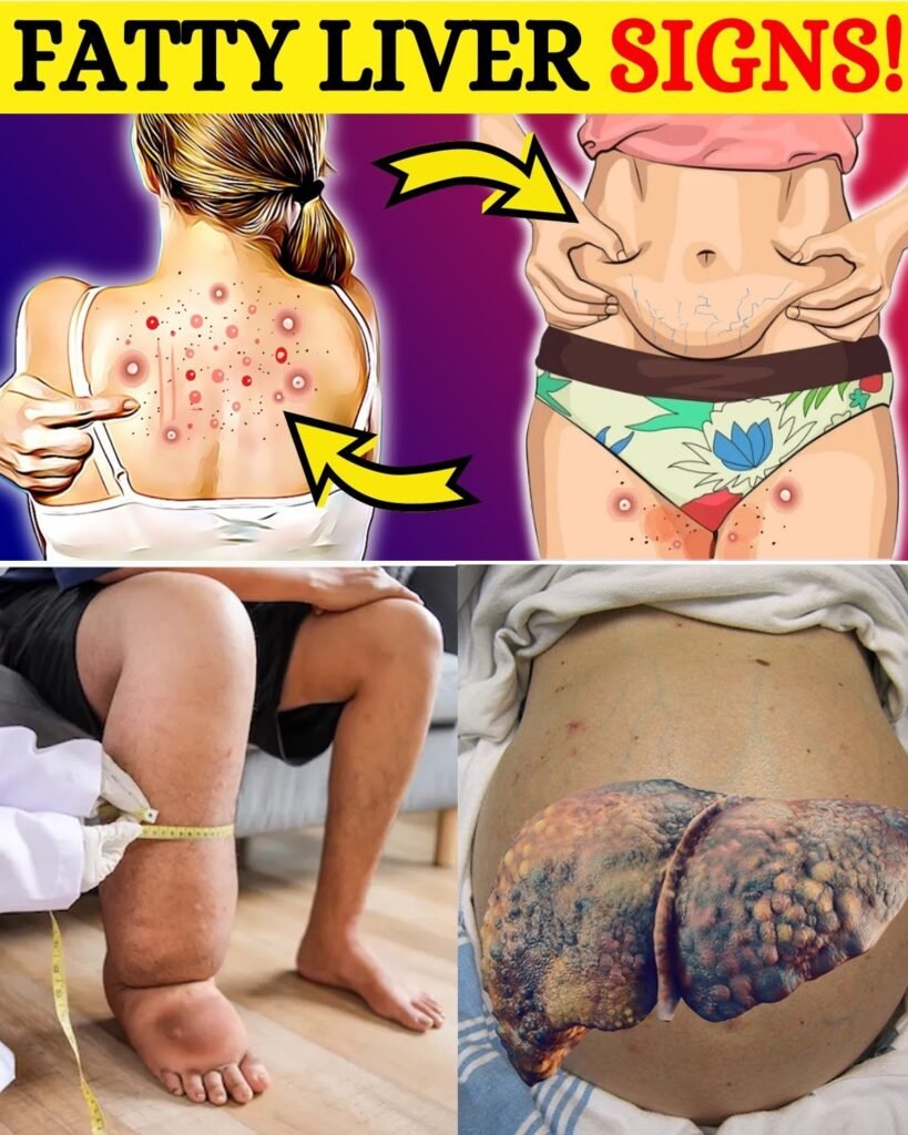 The Silent Killer Lurking Inside Millions: 8 Hidden Signs Your Liver Could Be Dying – Don’t Wait Until It’s Too Late