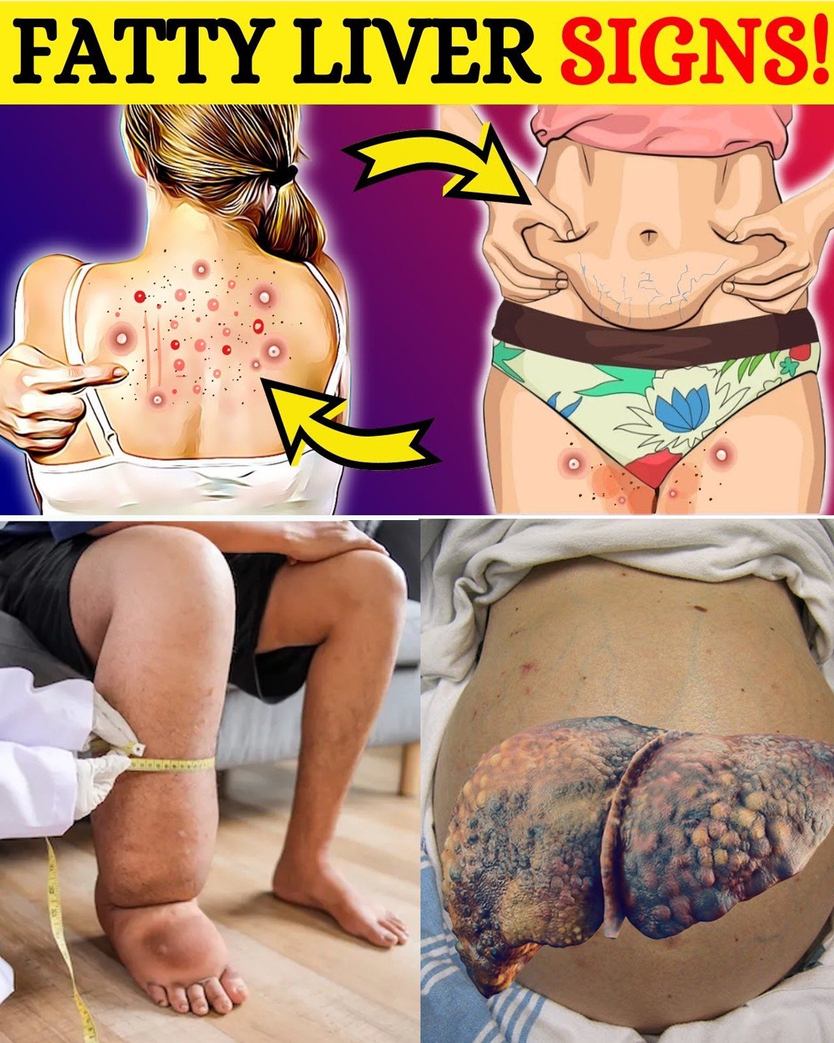 The Silent Killer Lurking Inside Millions: 8 Hidden Signs Your Liver Could Be Dying – Don’t Wait Until It’s Too Late