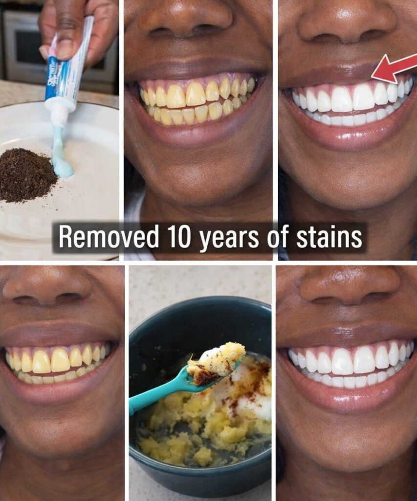 In Just 2 Minutes, Remove 10 Years of Teeth Stains – The Natural Whitener That Actually Works