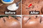 Those Stubborn Little White Bumps: Understanding Milia and Safe Ways to Improve Your Skin’s Appearance
