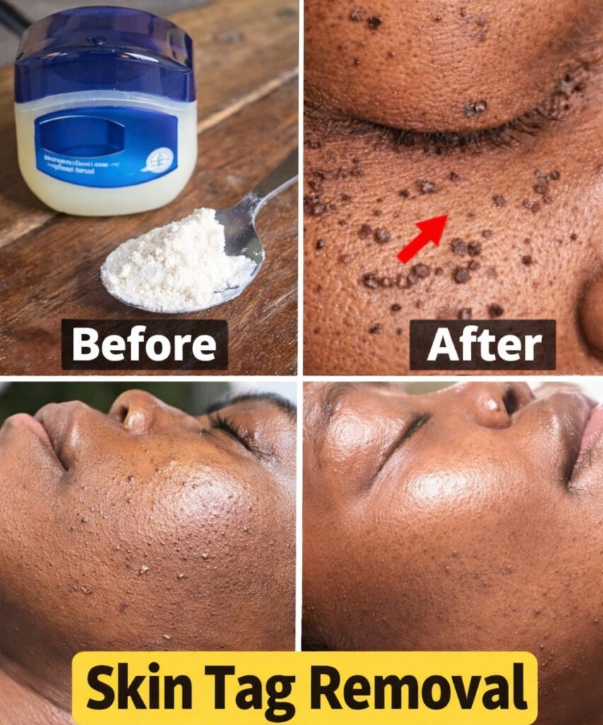 Those Stubborn Little White Bumps: Understanding Milia and Safe Ways to Improve Your Skin’s Appearance