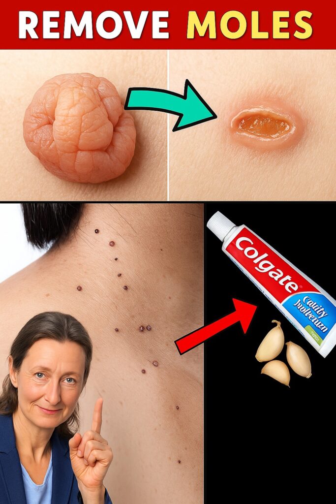 🌿 Say Goodbye to Warts & Skin Tags Naturally – With Just 3 Kitchen Ingredients!