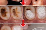 5 Simple Natural Home Remedies to Help Prevent Cavities and Support Healthy Teeth