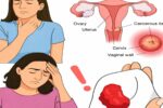 Cervical Cancer: Early Signs and Symptoms You Should Never Ignore