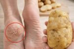 Just One Potato Can Help Soften Cracked Heels and Ease Discomfort