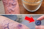 10 Natural Ways to Get Rid of Varicose Veins and Boost Blood Flow Naturally