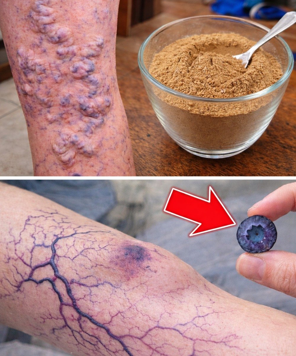 10 Natural Ways to Get Rid of Varicose Veins and Boost Blood Flow Naturally