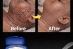 How to remove skin tags in one night naturally at home best skin tag removal vaseline