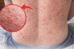 Persistent Itchy Rash on the Back What It Might Mean and Helpful Daily Care Habits