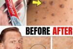 Say Goodbye to Warts & Skin Tags—The Natural Way That Works