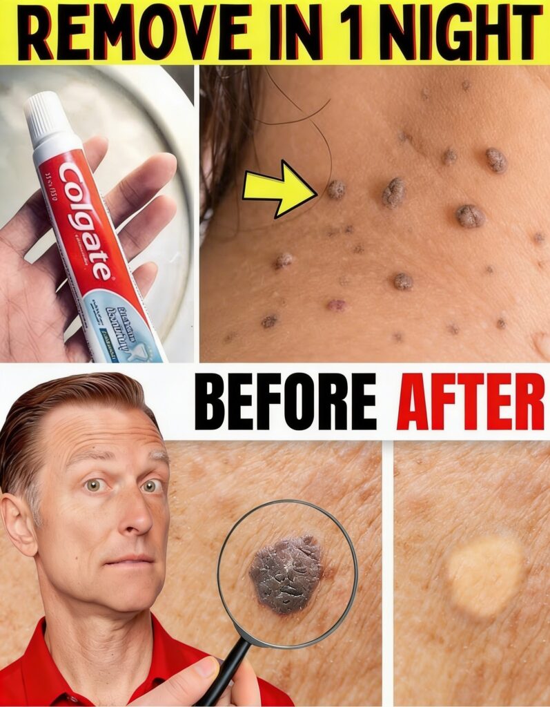 Say Goodbye to Warts & Skin Tags—The Natural Way That Works