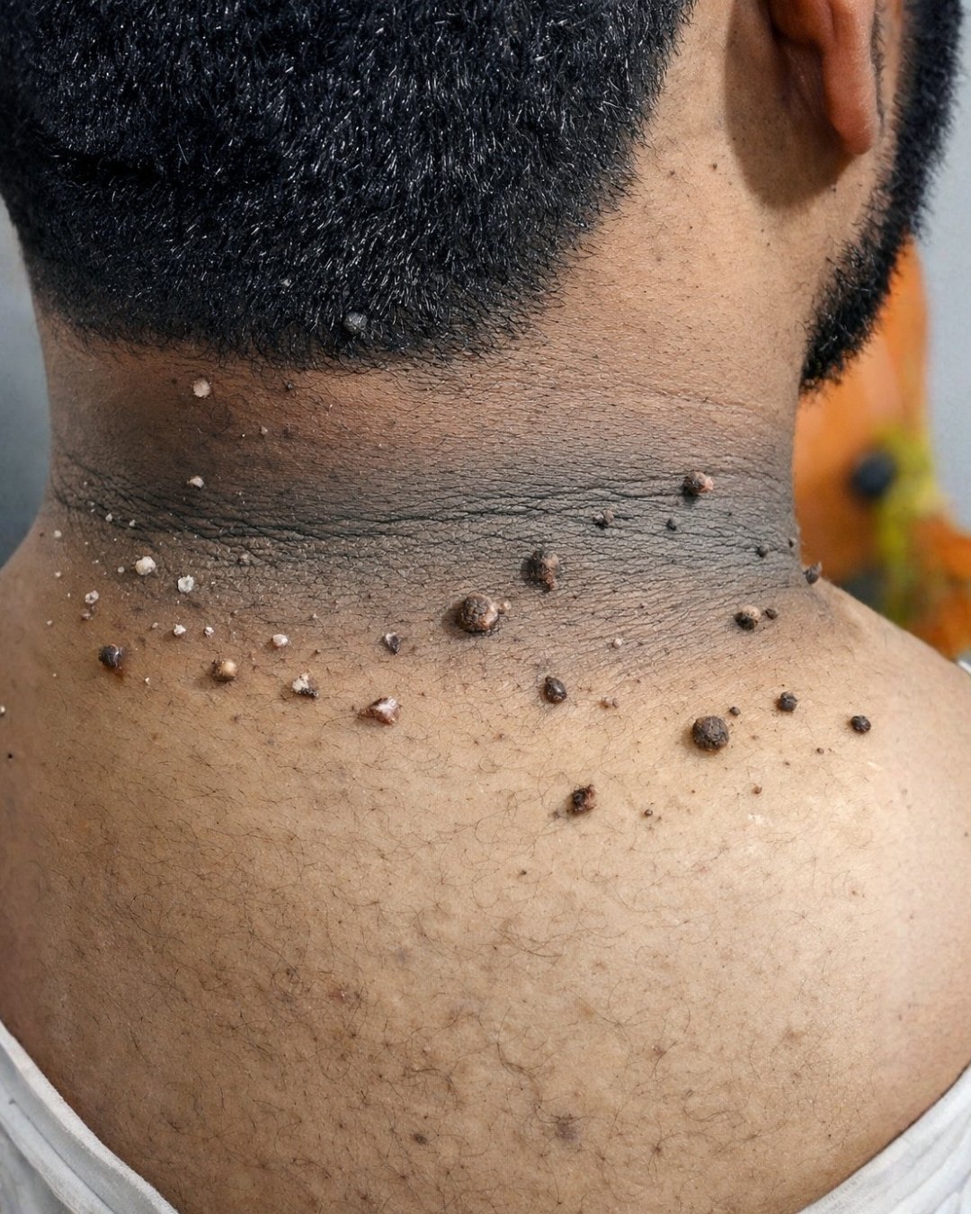 Early Warning Signs of Insulin Resistance: 8 Clues You Shouldn’t Ignore