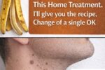Do Banana Peels Really Help Remove Warts? A Simple Home Remedy Explained