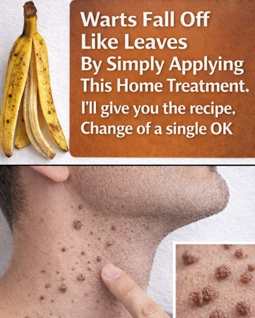 Do Banana Peels Really Help Remove Warts? A Simple Home Remedy Explained