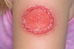 Red Circular Rash on a Child’s Arm: Causes, Symptoms, and What Parents Should Do