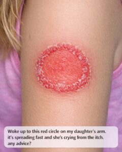 Red Circular Rash on a Child’s Arm: Causes, Symptoms, and What Parents ...