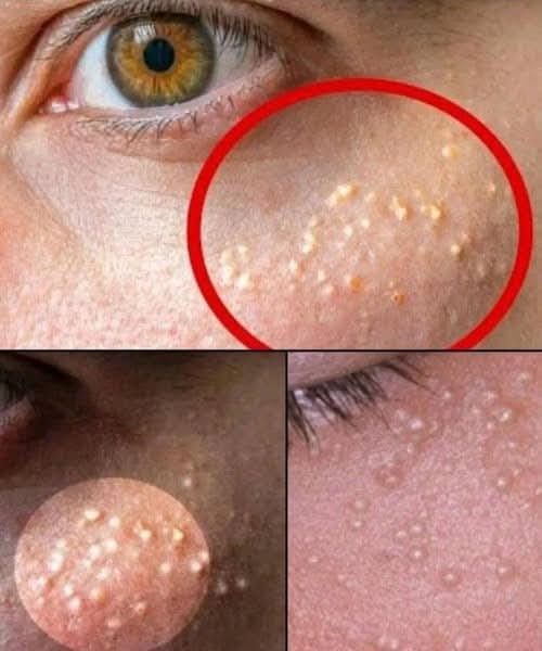 If you have these tiny, white spots on your face, do not try to remove them. Here’s what you should do instead: