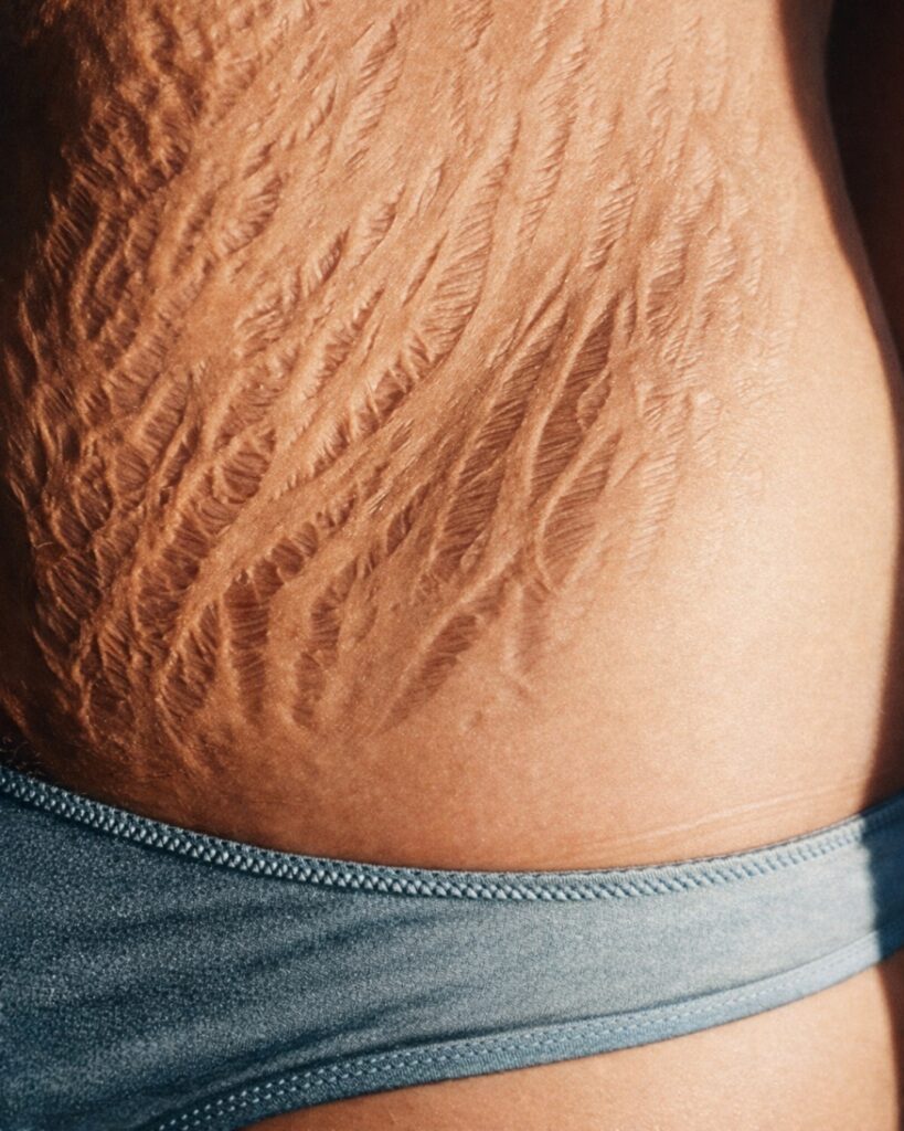 Stretch Marks: Causes, Prevention, and How to Handle Them Effectively