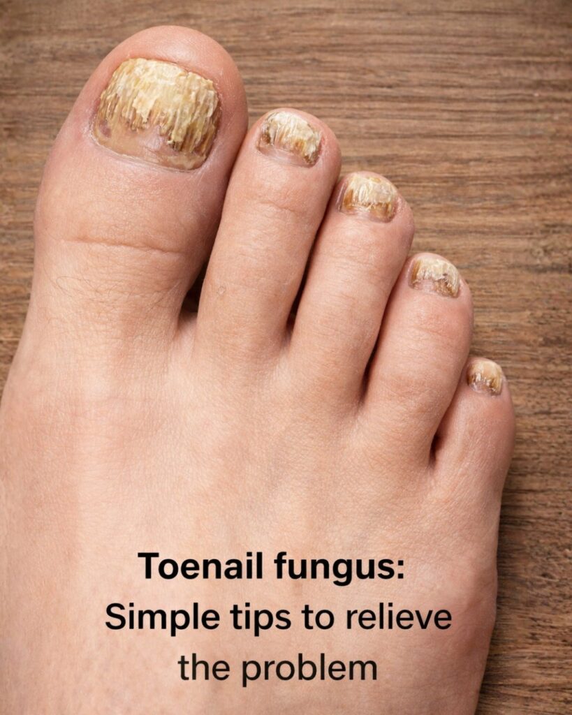 Nail Fungus: Simple Tips to Relieve and Treat This Common Condition