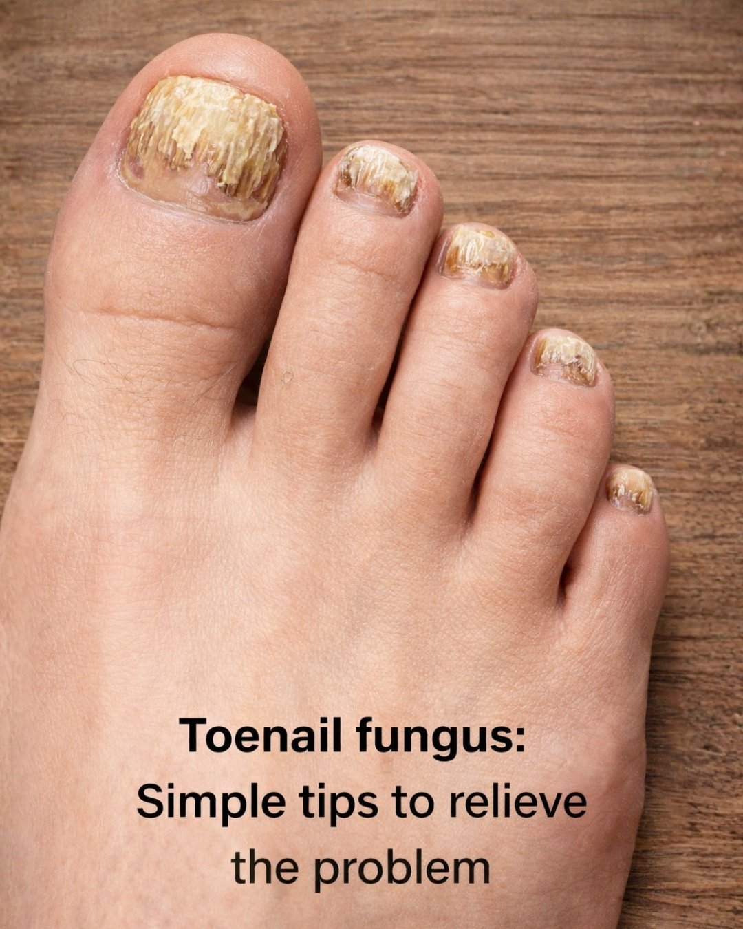 Nail Fungus: Simple Tips to Relieve and Treat This Common Condition